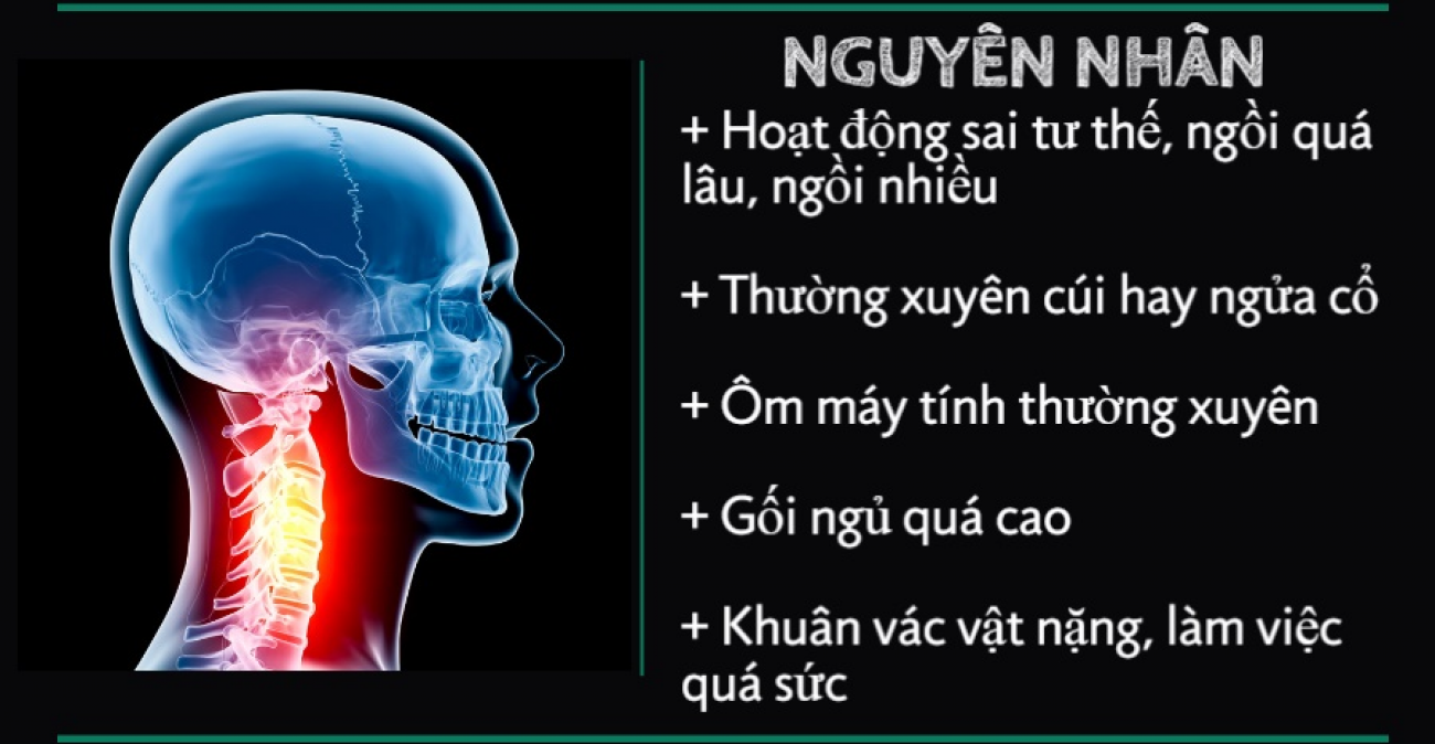 thoái hóa đốt sống gây đau mỏi cổ, vai, gáy