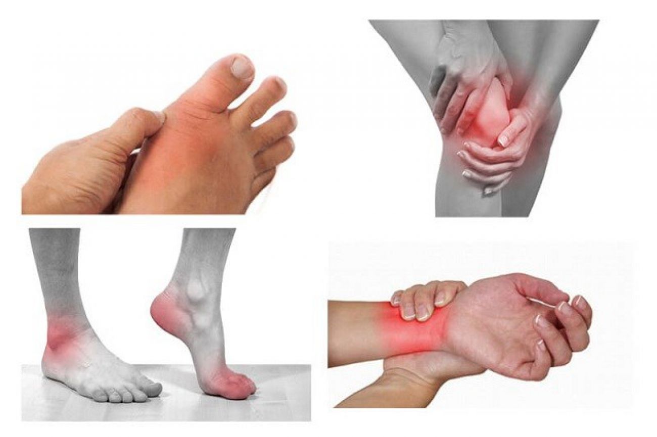 Bệnh viêm khớp là gì? Triệu chứng, Nguyên Nhân và điều trị bệnh viêm khớp.