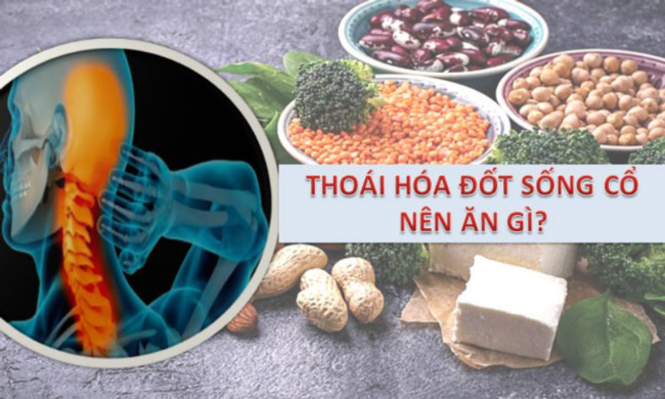 Nếu đau lưng, đau cổ vai gáy do thoái hóa cột sống nên ăn gì và hạn chế ăn gì?