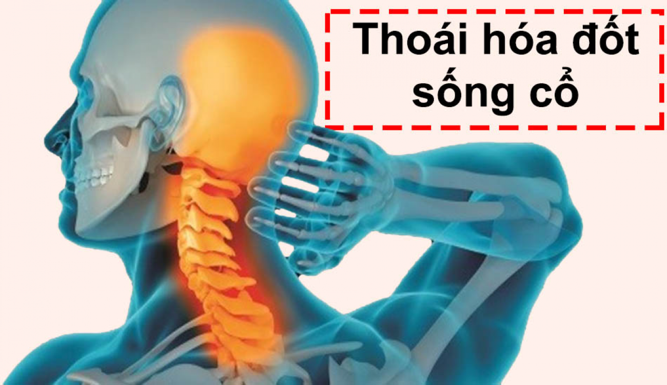 Thoái hóa đốt sống cổ vai gáy, Nguyên nhân và cách điều trị
