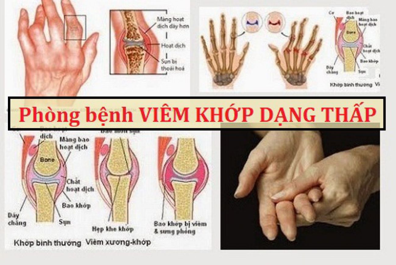 Một số bệnh về xương khớp thường gặp và cách điều trị